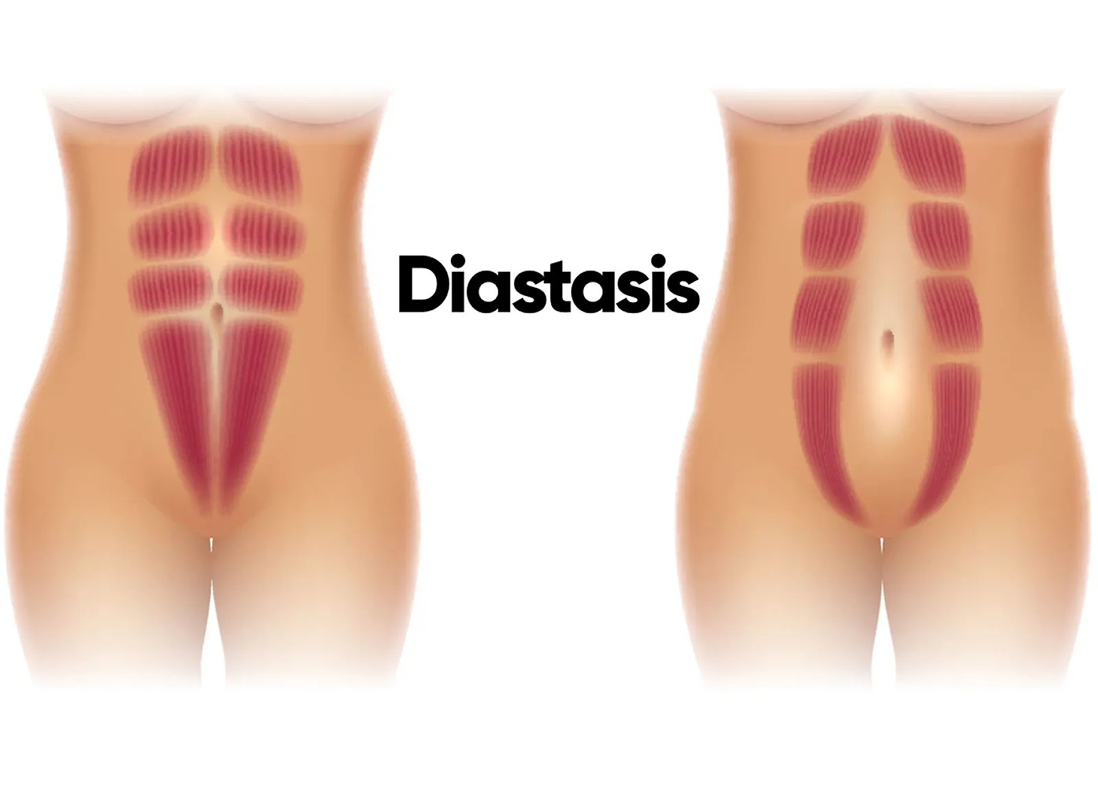 diastasis button.jpg